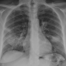 Chest radiograph (frontal view)