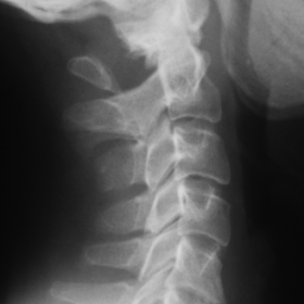 Lateral radiograph of the cervical spine