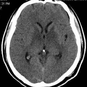 cranial CT scan