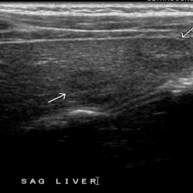 Gray-scale ultrasound of the liver