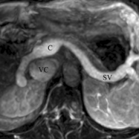 Contrast-enhanced dynamic MRI and secondary MIP-reconstruction through the upper abdomen.