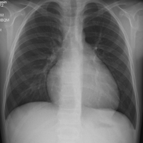 Posteroanterior chest X ray