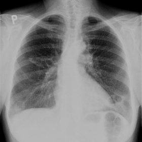 PA chest radiograph