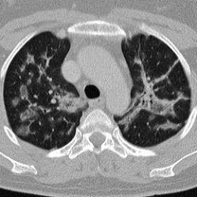 Lung CT