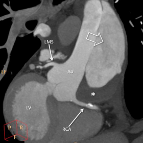 Oblique multi-planar view of ascending aorta and left ventricle.
