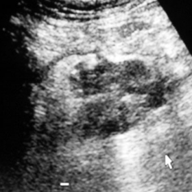 Abdominal ultrasound right lower quadrant