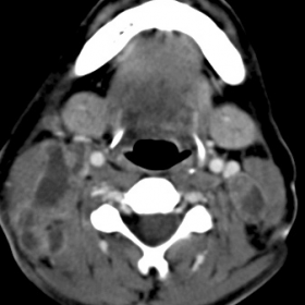 Axial post-contrast cervical CT scan