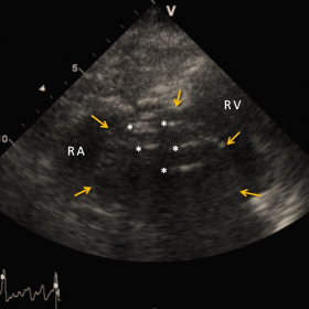 Echocardiogram of right heart