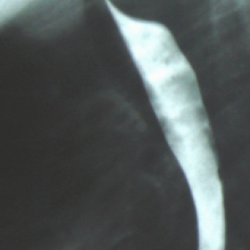 Lateral view of barium esophagogram