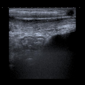 Ultrasound of the abdominal wall