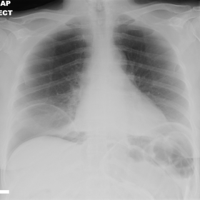 Pneumoperitoneum on erect chest x-ray