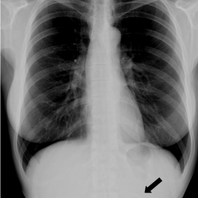 Plain radiograph of the chest.
