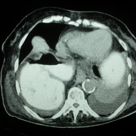 CT scan:axial view