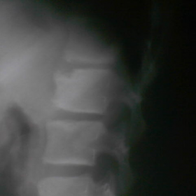 Plain radiograph (profile) of the lumbar spine-spot view D12-L3