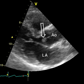Transthoracic Echo Findings