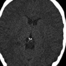 Axial pre-contrast brain CT examination