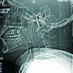 CT scannogram