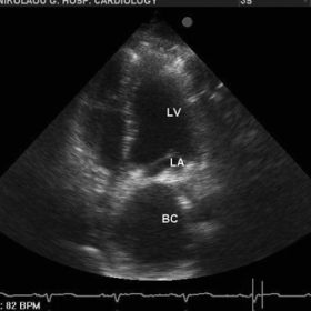 Cardiac ultrasound examination