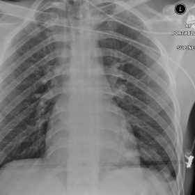 An AP supine chest radiograph showing a cyst above the left hemidiaphragm