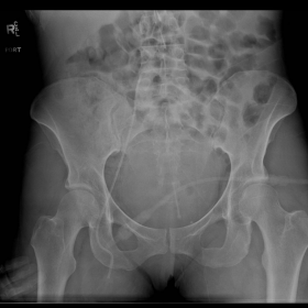 Frontal radiograph of the pelvis