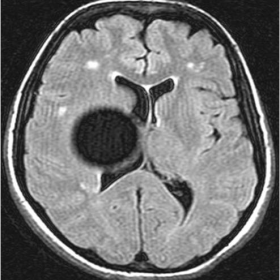 Axial flair weighted MRI sequence