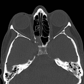 Paranasal sinuses CT
