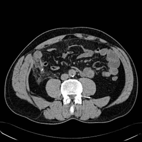 NECT of the right lower abdominal quadrant.