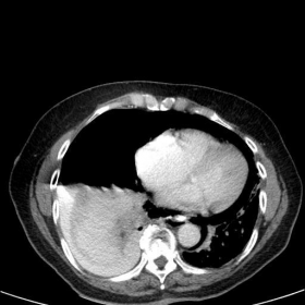 Contrast enhanced chest CT