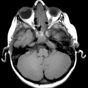 Axial T1 shows a subtle abnormality on left petrous apex