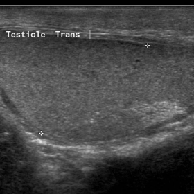 Transverse ultrasound images showing normal homogenous echopattern of both testicles.