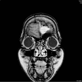 Coronal contrast enhanced MRI