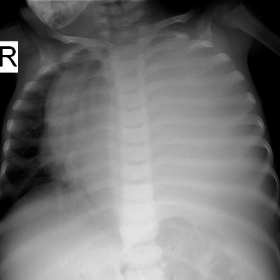 X-ray chest & abdomen