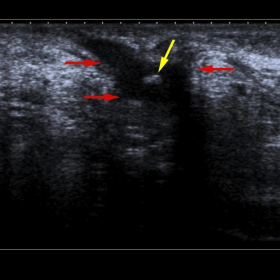 Inguinal gray scale ultrasonography