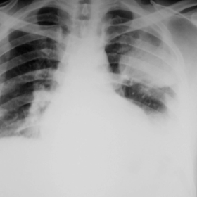 Initial PA-chest radiograph