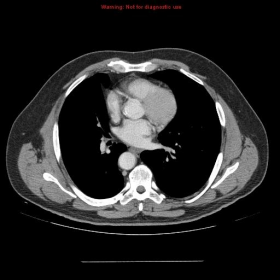 CT thorax axial