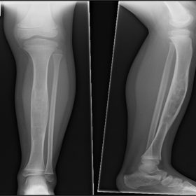 Plain radiographs left leg