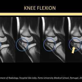 Knee flexion - Parasagittal T1 weighted MRI.