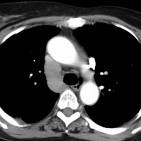 Contrast-enhanced CT of thorax and abdomen (soft tissue window)