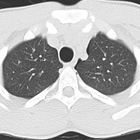 CT of the thorax. Lung window.