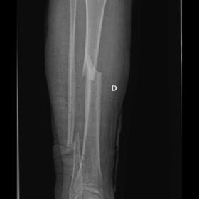 Conventional radiograph of right tibia and fibula