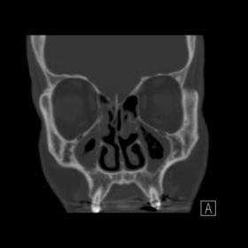 Sinus CT - coronal image