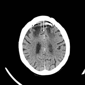 Unenhanced brain CT
