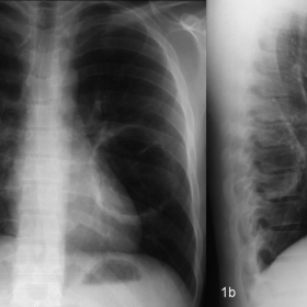 Chest radiograph (frontal and lateral view)