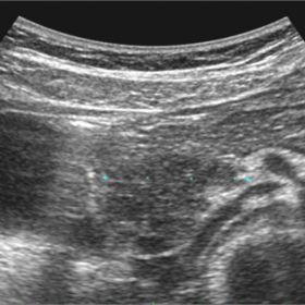 Axial ultrasound