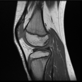Sagittal T1 sequence left knee