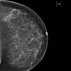 LCC mammography