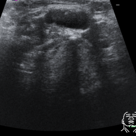 Cervical ultrasound