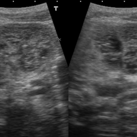 Sagittal and transverse renal US images