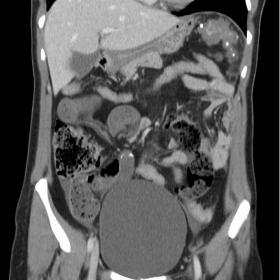 Fluid-filled formation in right iliac fossa with calcifications