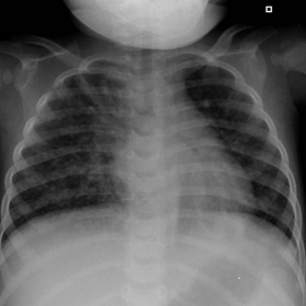 Supine chest radiograph